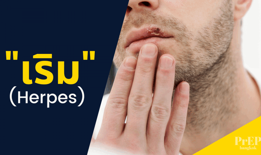 โรคเริม (HERPES)รักษาได้แต่ไม่หายขาด